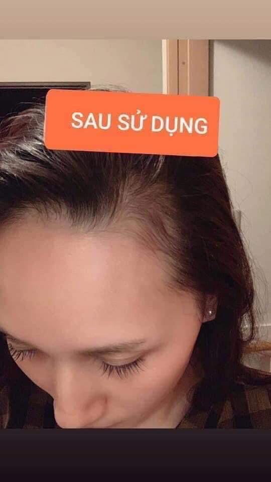 Dung Dịch Dưỡng Da Đầu Sato Arovics Solution 5% – 30ml x 12 Chai - VT Glamour